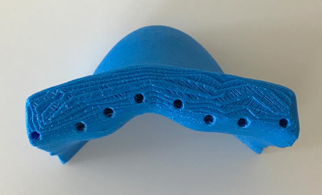 Imagen: Un aplicador de contornos de superficie HDR para la braquiterapia creado con el Bolus 3D (Fotografía cortesía de Adaptiiv). Imagen: Un aplicador de contornos de superficie HDR para la braquiterapia creado con el Bolus 3D (Fotografía cortesía de Adaptiiv).