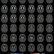 Imagen: Una técnica de resonancia magnética altamente exacta puede monitorizar los niveles de hierro en el cerebro de los pacientes con esclerosis múltiple (Fotografía cortesía de la RSNA). Imagen: Una técnica de resonancia magnética altamente exacta puede monitorizar los niveles de hierro en el cerebro de los pacientes con esclerosis múltiple (Fotografía cortesía de la RSNA).
