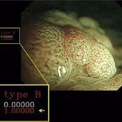 Imagen: Un nuevo estudio afirma que el diagnóstico asistido por computadora puede ayudar a identificar los pólipos cancerosos (Fotografía cortesía de Yuichi Mori / SUHY).