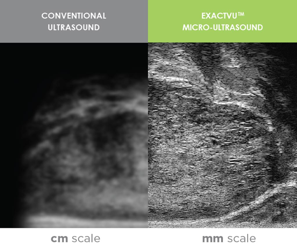 Imagen: Se está combinando una nueva técnica avanzada de imágenes de ultrasonido con inteligencia artificial para mejorar la detección del cáncer de próstata (Fotografía cortesía de Exact Imaging). Imagen: Se está combinando una nueva técnica avanzada de imágenes de ultrasonido con inteligencia artificial para mejorar la detección del cáncer de próstata (Fotografía cortesía de Exact Imaging).