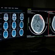 Imagen: Los algoritmos de IA coinciden con los radiólogos en la detección de patologías en las radiografías de tórax y en las TC (Fotografía cortesía de Qure.ai). Imagen: Los algoritmos de IA coinciden con los radiólogos en la detección de patologías en las radiografías de tórax y en las TC (Fotografía cortesía de Qure.ai).