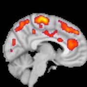Imagen: La TEP resalta la activación glial aumentada en los pacientes con fibromialgia (Fotografía cortesía de Marco Loggia/MGH). Imagen: La TEP resalta la activación glial aumentada en los pacientes con fibromialgia (Fotografía cortesía de Marco Loggia/MGH).
