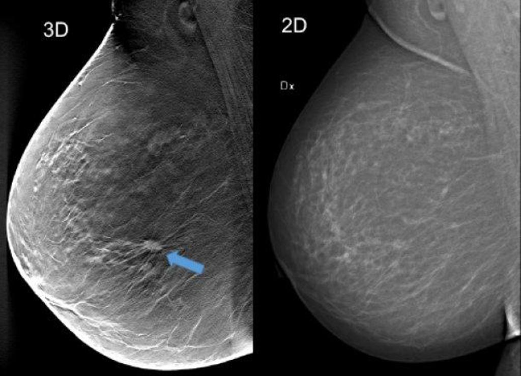 Imagen: Al utilizar la tomosíntesis de seno (cribado en 3D) en la imagen de la izquierda (una compuesta por aproximadamente 50 cortes finos de imágenes de corte transversal del seno), se puede ver un tumor de aproximadamente 1 cm que no es claramente visible en la imagen de la mamografía en la derecha, aunque el seno no contiene tejido particularmente denso (Fotografía cortesía del Hospital Universitario de Skåne en Malmö). Imagen: Al utilizar la tomosíntesis de seno (cribado en 3D) en la imagen de la izquierda (una compuesta por aproximadamente 50 cortes finos de imágenes de corte transversal del seno), se puede ver un tumor de aproximadamente 1 cm que no es claramente visible en la imagen de la mamografía en la derecha, aunque el seno no contiene tejido particularmente denso (Fotografía cortesía del Hospital Universitario de Skåne en Malmö).