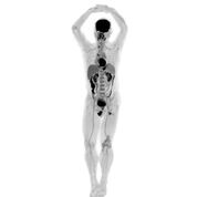 Imagen: Un examen PET/TC de cuerpo completo en el escáner Explorer (Fotografía cortesía de UCD).