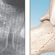 Imagen: El implante subtalar PitStop está hecho de PEEK, lo que lo hace más suave que los implantes de metal (Fotografía cortesía de In2Bones Global).