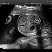 Imagen: El aprendizaje profundo y la inteligencia artificial (AI) transforman los exámenes de ultrasonido obstétrico en una experiencia más fácil, más rápida, más consistente y mucho más exacta (Fotografía cortesía de SonoScape).