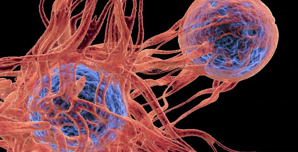 Imagen: Una herramienta nueva de inteligencia artificial puede predecir la gravedad de los tres síntomas comunes que enfrentan los pacientes con cáncer (Fotografía cortesía de SPL).