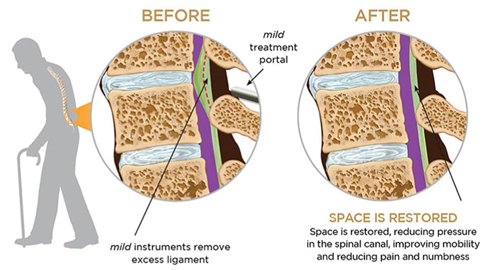 Imagen: En el procedimiento de la columna vertebral, la eliminación del exceso de tejido en la columna lumbar alivia la LSS (Fotografía cortesía de Vertos Medical).