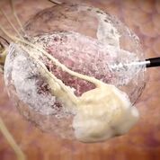 Imagen: Un tumor “bola de hielo” creado durante el tratamiento con crioablación (Fotografía cortesía de IceCure Medical).