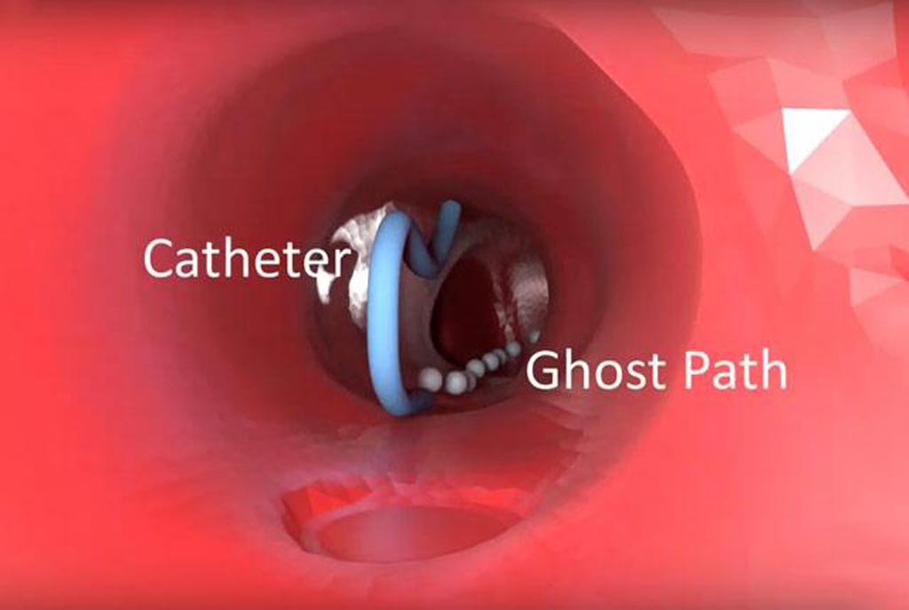 Imagen: Con el software nuevo de RV, los radiólogos intervencionistas pueden navegar un catéter a través de uniones y ángulos anatómicos (Fotografía cortesía de UW Medicine). Imagen: Con el software nuevo de RV, los radiólogos intervencionistas pueden navegar un catéter a través de uniones y ángulos anatómicos (Fotografía cortesía de UW Medicine).