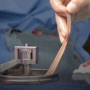 Imagen: Una recuperación quirúrgica de un injerto de piel utilizando el Amalgatome SD (Fotografía cortesía de Exsurco Medical).