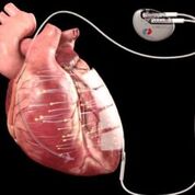 Imagen: El dispositivo implantado diseñado para estimular la regeneración celular en la miocardiopatía (Fotografía cortesía de Berlin Heals).