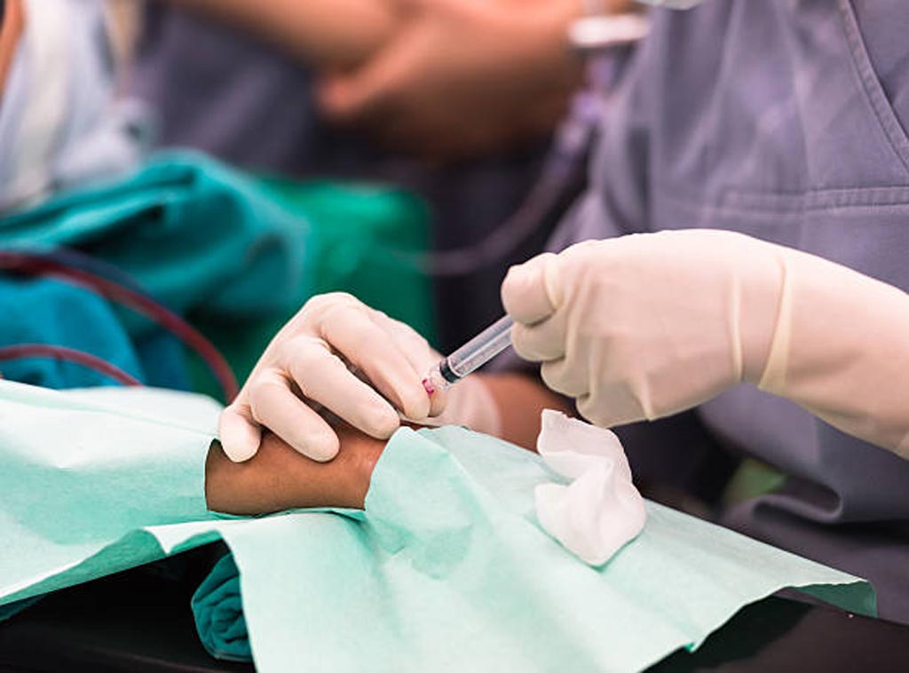 Imagen: Un estudio nuevo muestra que se prefiere el acceso a través de la arteria radial para los procedimientos neuroendovasculares (Fotografía cortesía de iStock). Imagen: Un estudio nuevo muestra que se prefiere el acceso a través de la arteria radial para los procedimientos neuroendovasculares (Fotografía cortesía de iStock).