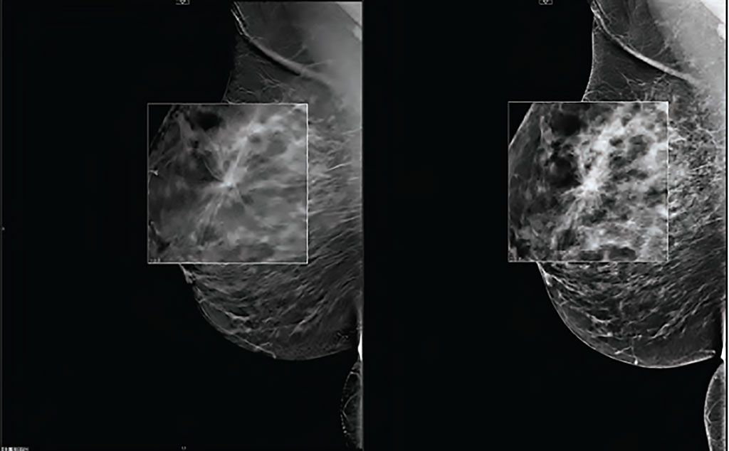 Imagen: La TDM puede aumentar las tasas de detección de cáncer de seno (Fotografía cortesía de Carestream)