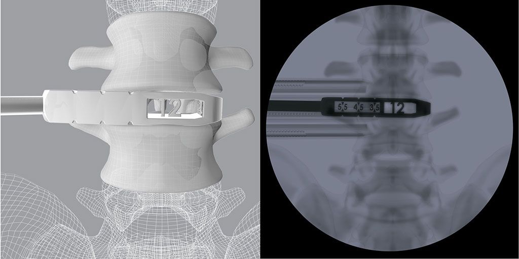 Imagen: Las pruebas 3D OLIF cuentan con mediciones de altura y longitud visibles solo bajo fluoroscopia (Fotografía cortesía de CoreLink)