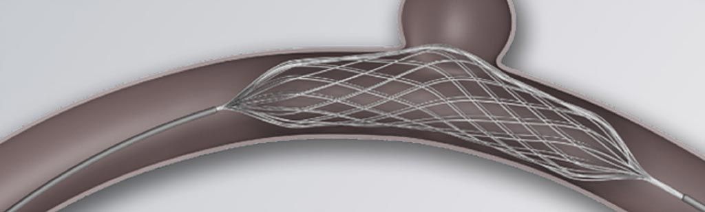 Imagen: El stent de malla de remodelación ajustable, Comaneci (Fotografía cortesía de Rapid Medical)