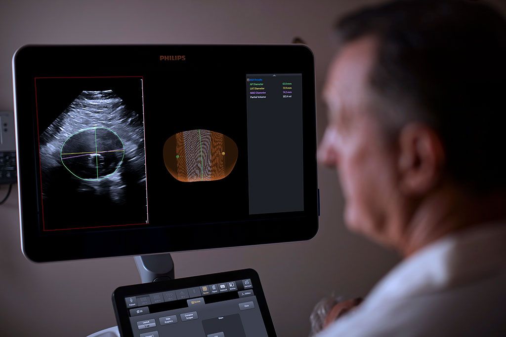 Imagen: Un modelo nuevo de ultrasonido ayuda a monitorear la progresión de los AAA (Fotografía cortesía de Philips)