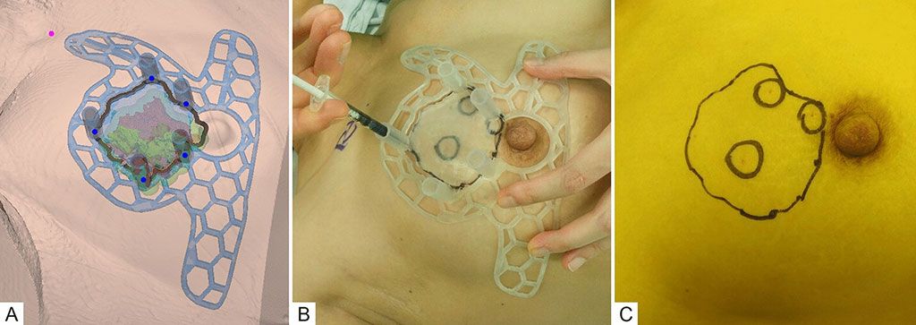 Imagen: Modelado 3DP-BSG basado en RM (A); marca en la superficie de la piel con 3DP-BSG y ubicación del tumor dentro de la mama inyectando colorante azul (B); después de retirar la guía. (Fotografía cortesía de AMC)