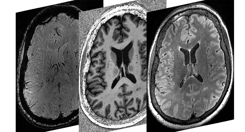 Imagen: Tres exploraciones de resonancia magnética 7T que demuestran el alto nivel de contraste y resolución que permite a los investigadores identificar el daño tisular después de la enfermedad COVID-19 (Fotografía cortesía de Rob Bartha / Instituto de Investigación Robarts)