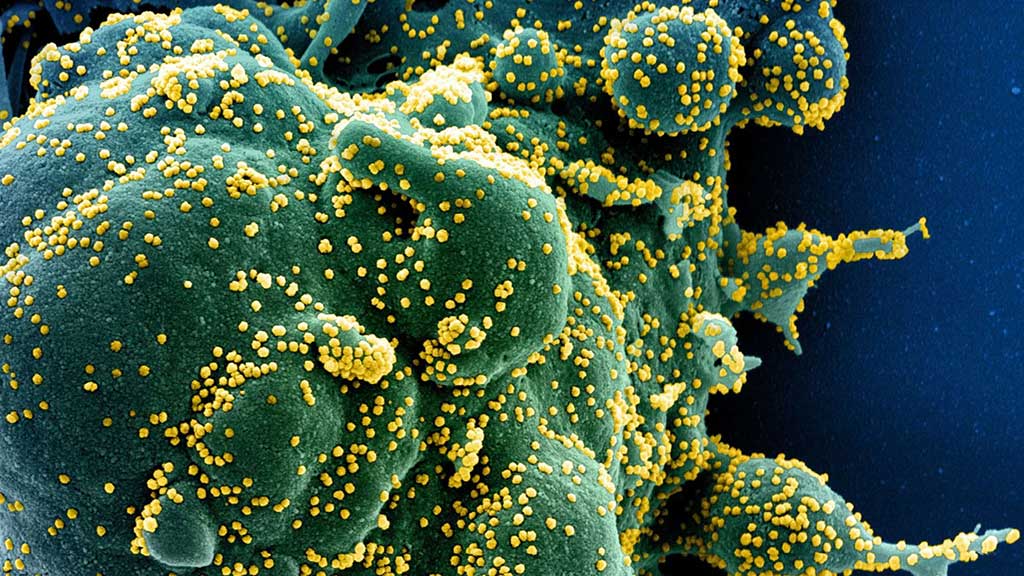 Imagen: los linfocitos de las células T inmunes pueden encontrar y destruir una célula (verde) infectada con SARS-CoV-2 (amarillo) y hacer copias (Fotografía cortesía del Instituto Nacional de Alergias y Enfermedades Infecciosas de los EUA)