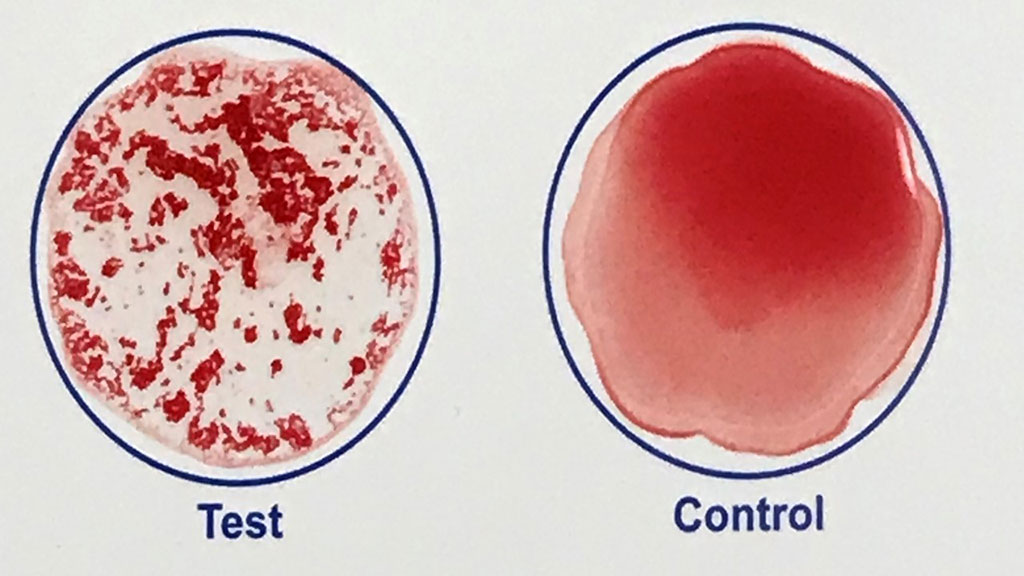 Imagen: Una imagen tomada de un video de YouTube muestra los resultados de un análisis de sangre rápido desarrollado por investigadores de Johns Hopkins que puede confirmar en minutos si una persona ha sido vacunada contra el SARS-CoV-2, el virus que causa la COVID-19 (Fotografía cortesía de Robert Kruse)