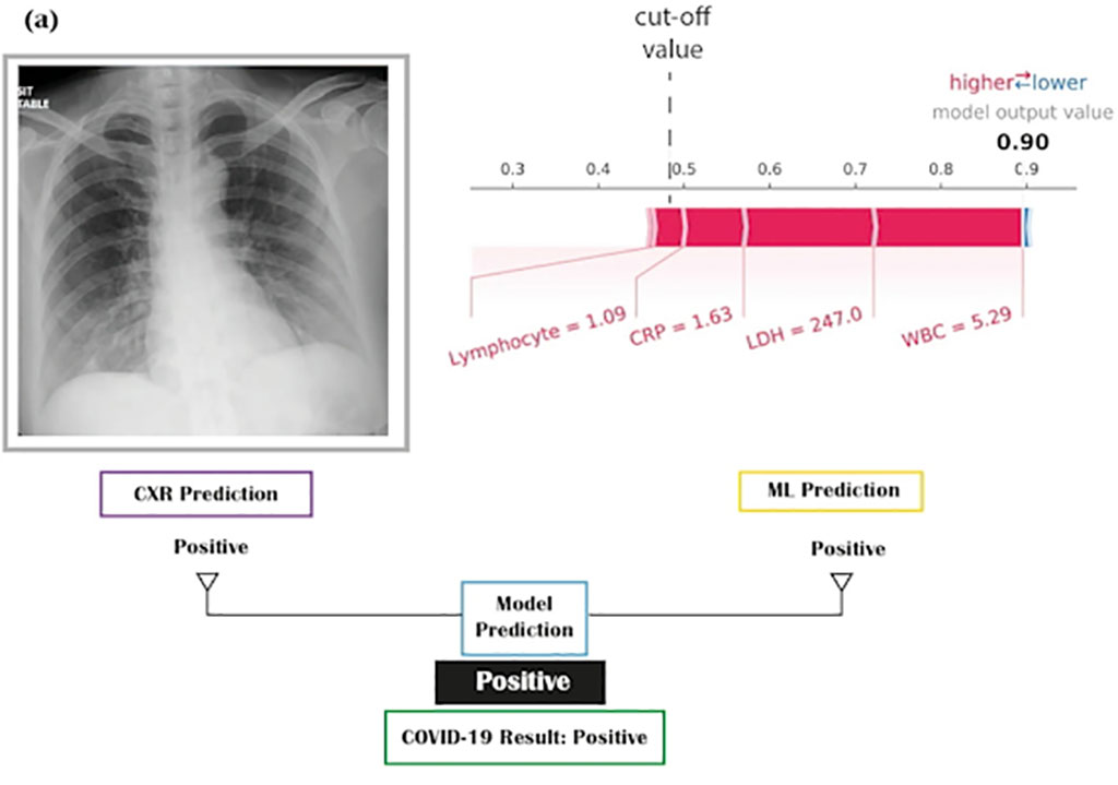 Imagen: El modelo de inteligencia artificial (IA) identifica a pacientes con COVID-19 mediante análisis de sangre y radiografías de tórax (Fotografía cortesía de Nature)