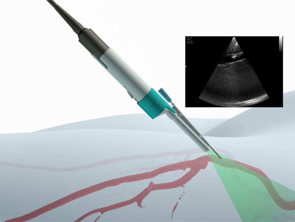 Imagen: El sistema de ultrasonido Vu-Path (Fotografía cortesía de Crystalline Medical) Imagen: El sistema de ultrasonido Vu-Path (Fotografía cortesía de Crystalline Medical)
