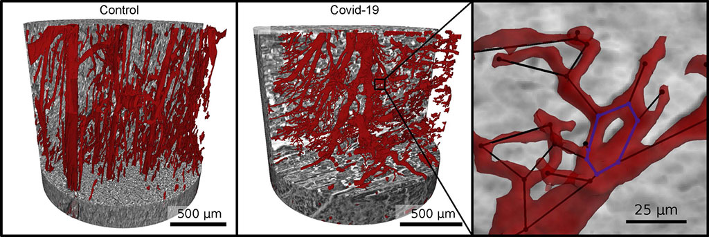 Imagen: Imagenología novedosa de rayos X que muestra el daño vascular en la COVID-19 podría respaldar los diagnósticos de laboratorio de rutina (Fotografía cortesía de M Reichardt, T Salditt)