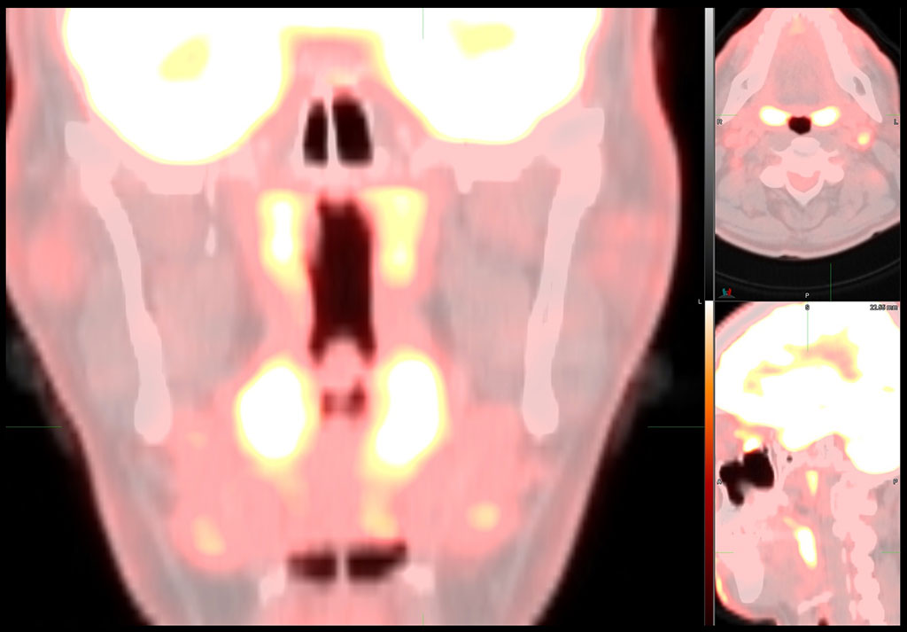 Imagen: Expertos en imagenología advierten que los exámenes PET/TC que muestran patrones inusuales podrían indicar infección por Omicron (Fotografía cortesía de SNMMI)