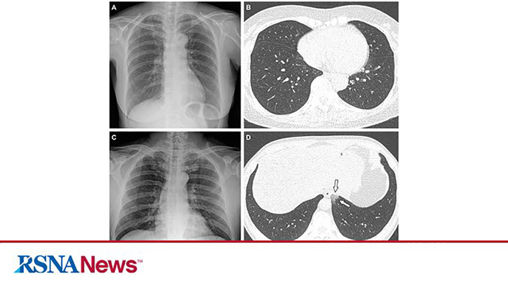 Imagen: Imágenes de rayos X y TC del tórax (Fotografía cortesía de RSNA)