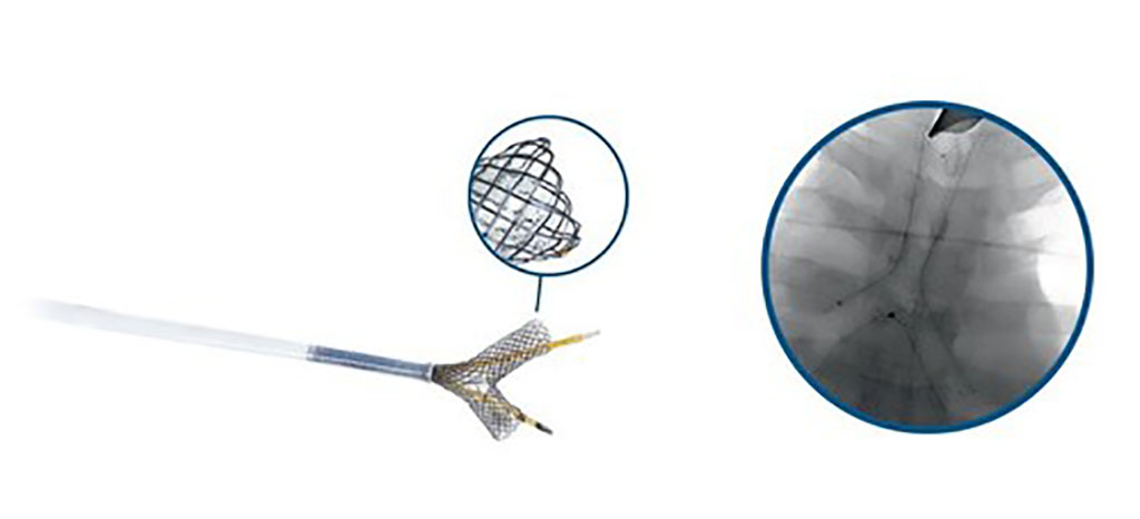 Imagen: Sistema de stent traqueal en forma de Y (Fotografía cortesía de Micro-Tech Endoscopy)