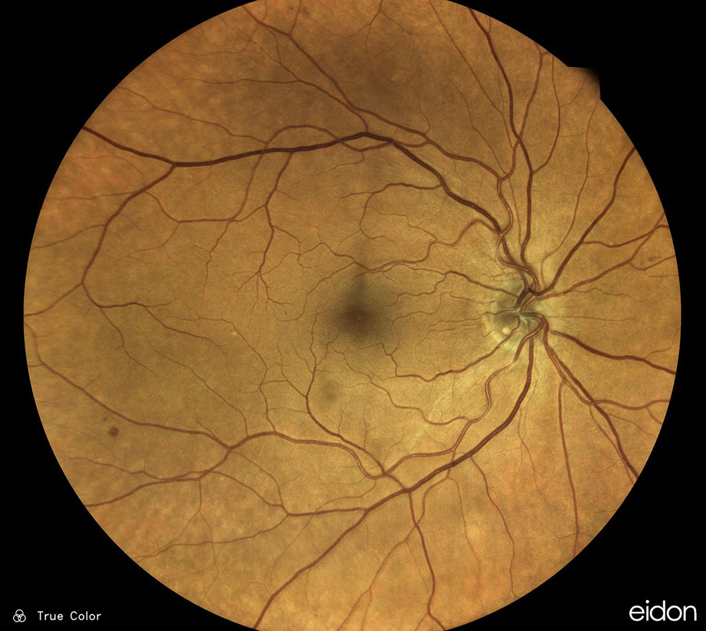 Imagen: El aprendizaje de instancias múltiples detecta la enfermedad arterial periférica a partir de fotografías de fondo de ojo en color de alta resolución (Fotografía cortesía de Mueller, S. y Wintergerst, M.W.M. et al.)