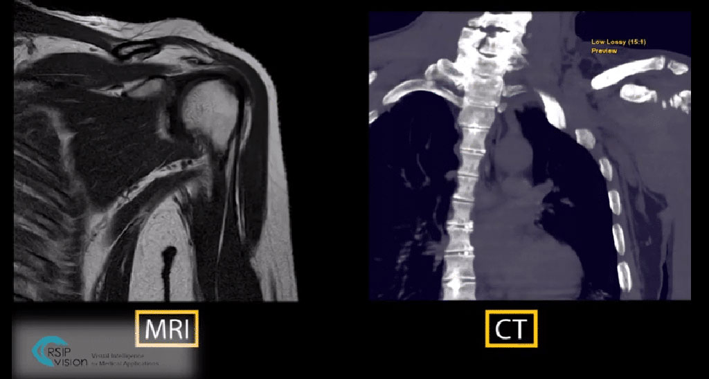 Imagen: herramienta de planificación de la artroplastia total de hombro (TSA) (Fotografía cortesía de RSIP Vision Ltd.)