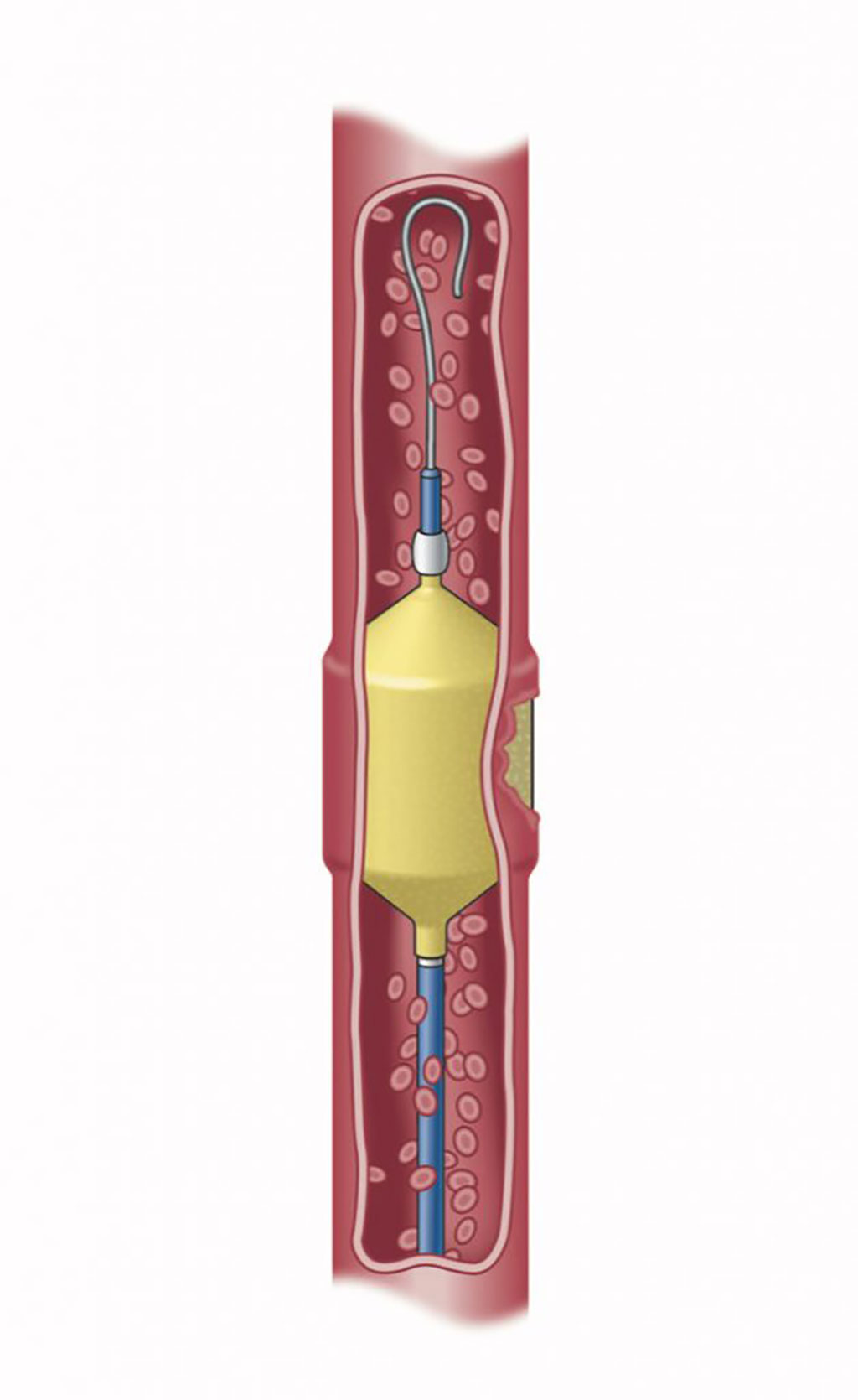 Imagen: Dispositivo de embolización Solus Gold (Fotografía cortesía de Artio Medical)