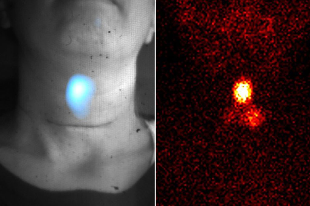 Imagen: Imágenes de Cerenkov de un tumor tiroideo capturan su ubicación y alta actividad (Fotografía cortesía de MSK) Imagen: Imágenes de Cerenkov de un tumor tiroideo capturan su ubicación y alta actividad (Fotografía cortesía de MSK)