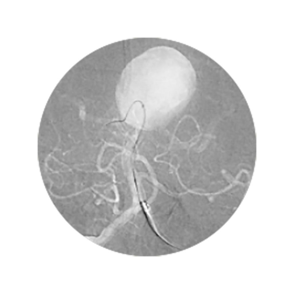 Imagen: Acceso a aneurisma de punta basilar gigante, vasos PCA que salen del saco del aneurisma, utilizando el Bendit21 (Fotografía cortesía de BENDIT Technologies)