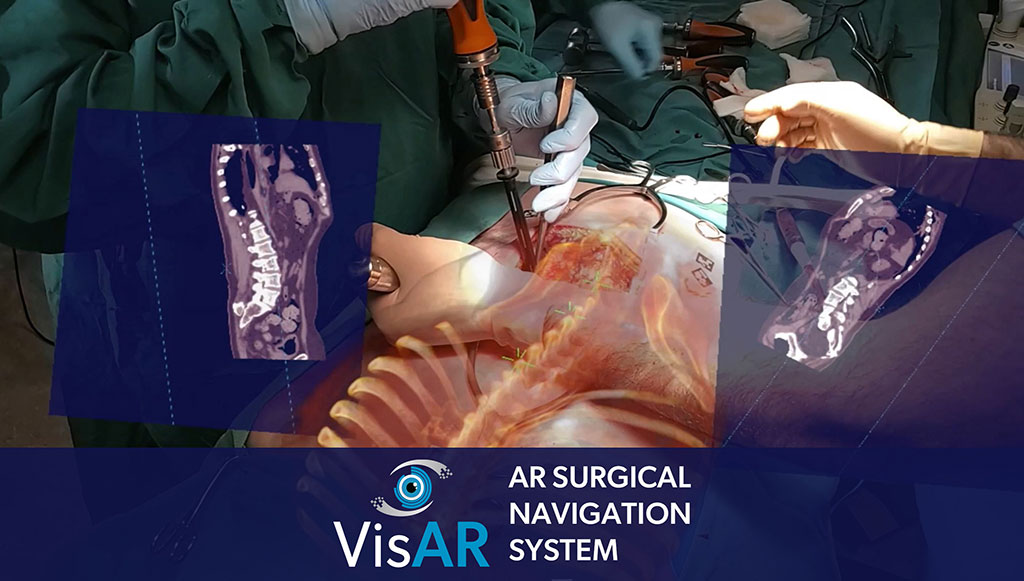 Imagen: El sistema VisAR es un gran paso para hacer que la orientación quirúrgica de precisión sea ampliamente disponible y económicamente factible (Fotografía cortesía de Novarad)