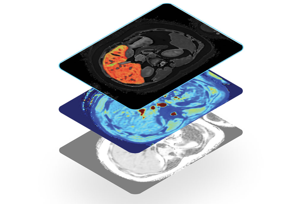 Imagen: LiverMultiScan proporciona tres métricas en un solo escaneo que representan la cantidad de fibroinflamación, grasa y hierro en el hígado (Fotografía cortesía de Perspectum) Imagen: LiverMultiScan proporciona tres métricas en un solo escaneo que representan la cantidad de fibroinflamación, grasa y hierro en el hígado (Fotografía cortesía de Perspectum)