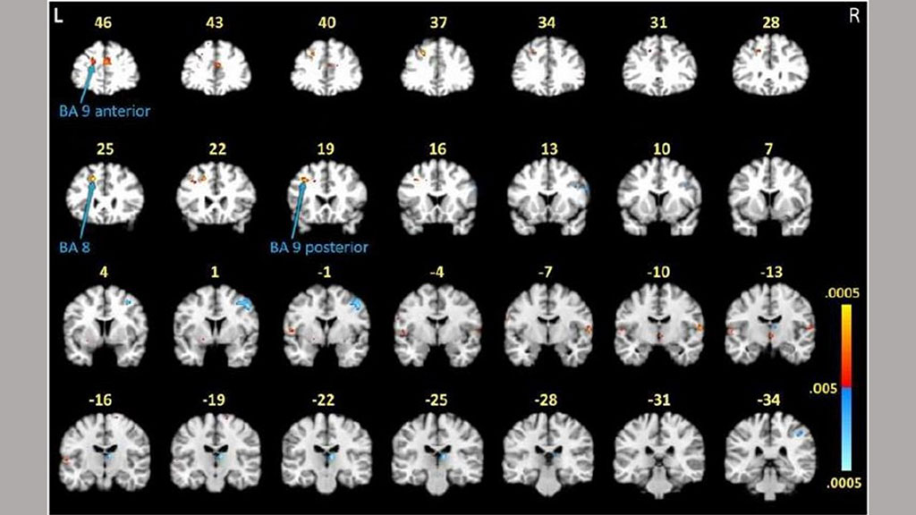 Imagen: Los escaneos cerebrales indican altos niveles de activación de materia blanca en los lóbulos frontales de los participantes con enfermedad de Lyme posterior al tratamiento (Fotografía cortesía de Johns Hopkins Medicine) Imagen: Los escaneos cerebrales indican altos niveles de activación de materia blanca en los lóbulos frontales de los participantes con enfermedad de Lyme posterior al tratamiento (Fotografía cortesía de Johns Hopkins Medicine)