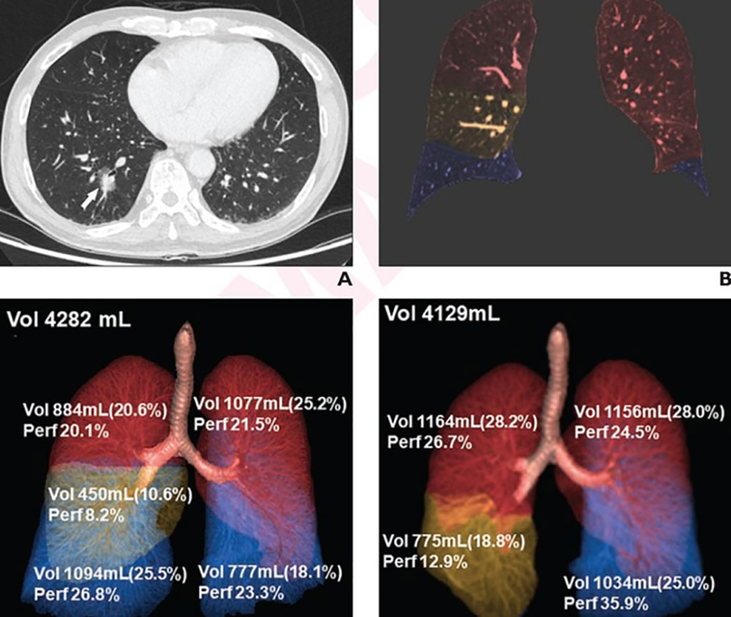 Imagen: DECT evalúa el volumen pulmonar postoperatorio y los cambios de perfusión (Fotografía cortesía de ARRS, AJR) Imagen: DECT evalúa el volumen pulmonar postoperatorio y los cambios de perfusión (Fotografía cortesía de ARRS, AJR)