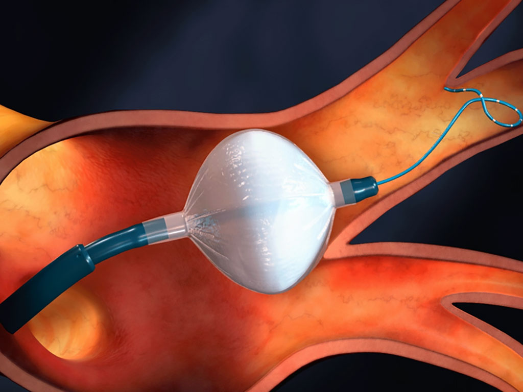 Imagen: Un nuevo estudio sugiere que es hora de repensar cómo tratamos la fibrilación auricular (Fotografía cortesía de UBC)