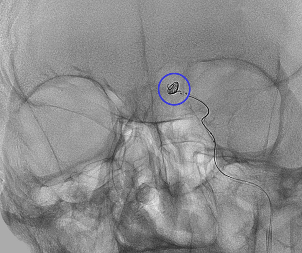 Imagen: El sistema intasacular Nautilus está diseñado para el tratamiento de aneurismas cerebrales (Fotografía cortesía de la EndoStream)