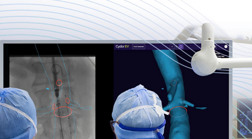 Imagen: Cydar EV Maps es una solución de nube integrada para la planificación, navegación y revisión de las cirugías endovasculares (Fotografía cortesía de Cydar)
