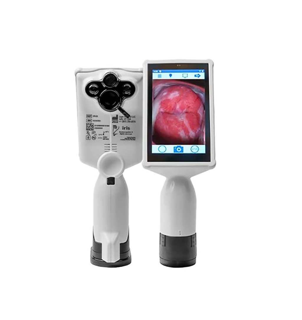 Imagen: El colposcopio digital EVApro de próxima generación está redefiniendo el examen de cuello uterino (Fotografía cortesía de MobileODT)