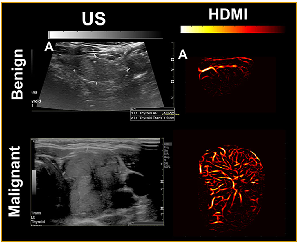 Imagen: Una combinación de ultrasonido avanzado e IA podría mejorar el diagnóstico de cáncer (Fotografía cortesía de la Clínica Mayo) Imagen: Una combinación de ultrasonido avanzado e IA podría mejorar el diagnóstico de cáncer (Fotografía cortesía de la Clínica Mayo)