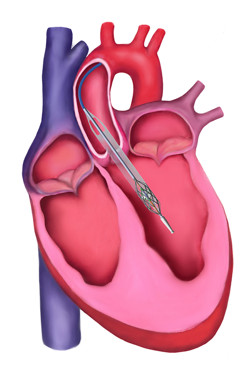 Imagen: El sistema Magenta Elevate se ha evaluado con éxito en un primer estudio en humano de pacientes con HR-PCI (Fotografía cortesía de Magenta Medical)