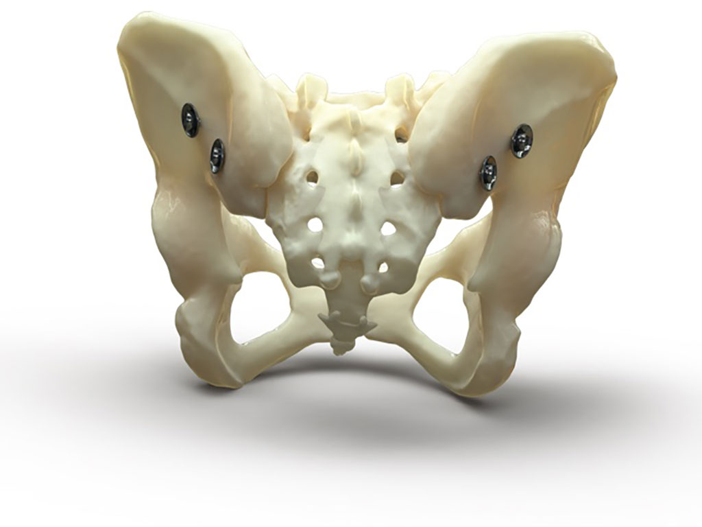 Imagen: demostración del Bone Bolt que se utiliza para reparar una fractura pélvica posterior (Fotografía cortesía de la Universidad de Utah Health)