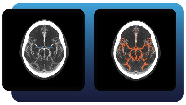 Imagen: Full Brain Solution identifica OVM y OVG además de aneurismas y hemorragias (Fotografía cortesía de Aidoc) Imagen: Full Brain Solution identifica OVM y OVG además de aneurismas y hemorragias (Fotografía cortesía de Aidoc)