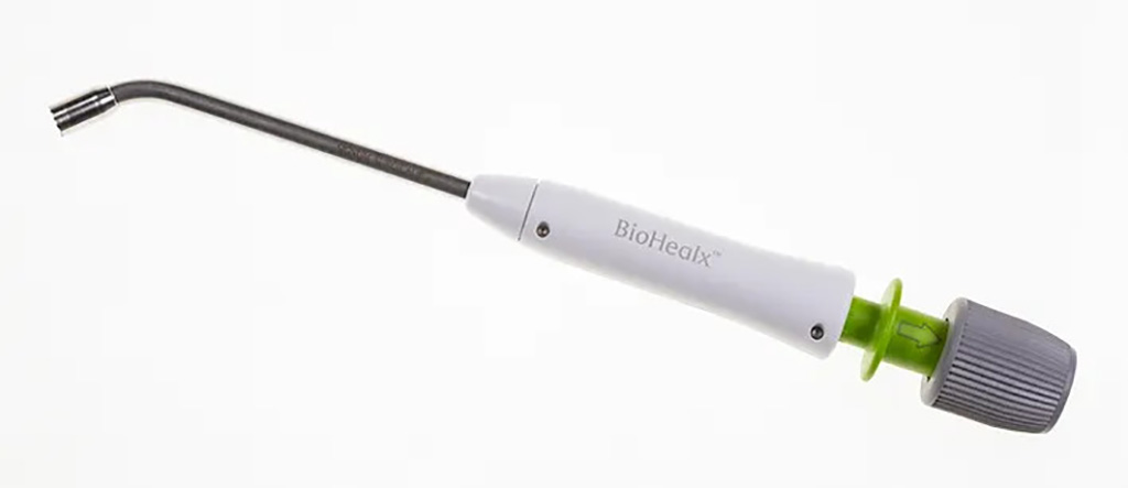 Imagen: Un ensayo clínico evaluó la seguridad y la eficacia del dispositivo BioHealx para el tratamiento de la fístula anal (Fotografía cortesía de Signum Surgical)