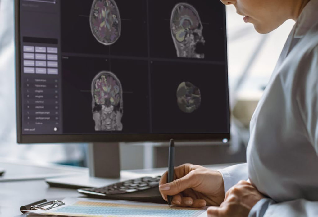 Imagen: VUNO Med-DeepBrain ayuda en la enfermedad neurodegenerativa utilizando RMN (Fotografía cortesía de VUNO) Imagen: VUNO Med-DeepBrain ayuda en la enfermedad neurodegenerativa utilizando RMN (Fotografía cortesía de VUNO)